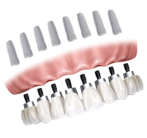 dentisti croazia impianto dentale