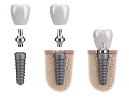 dentisti croazia impianto dentale
